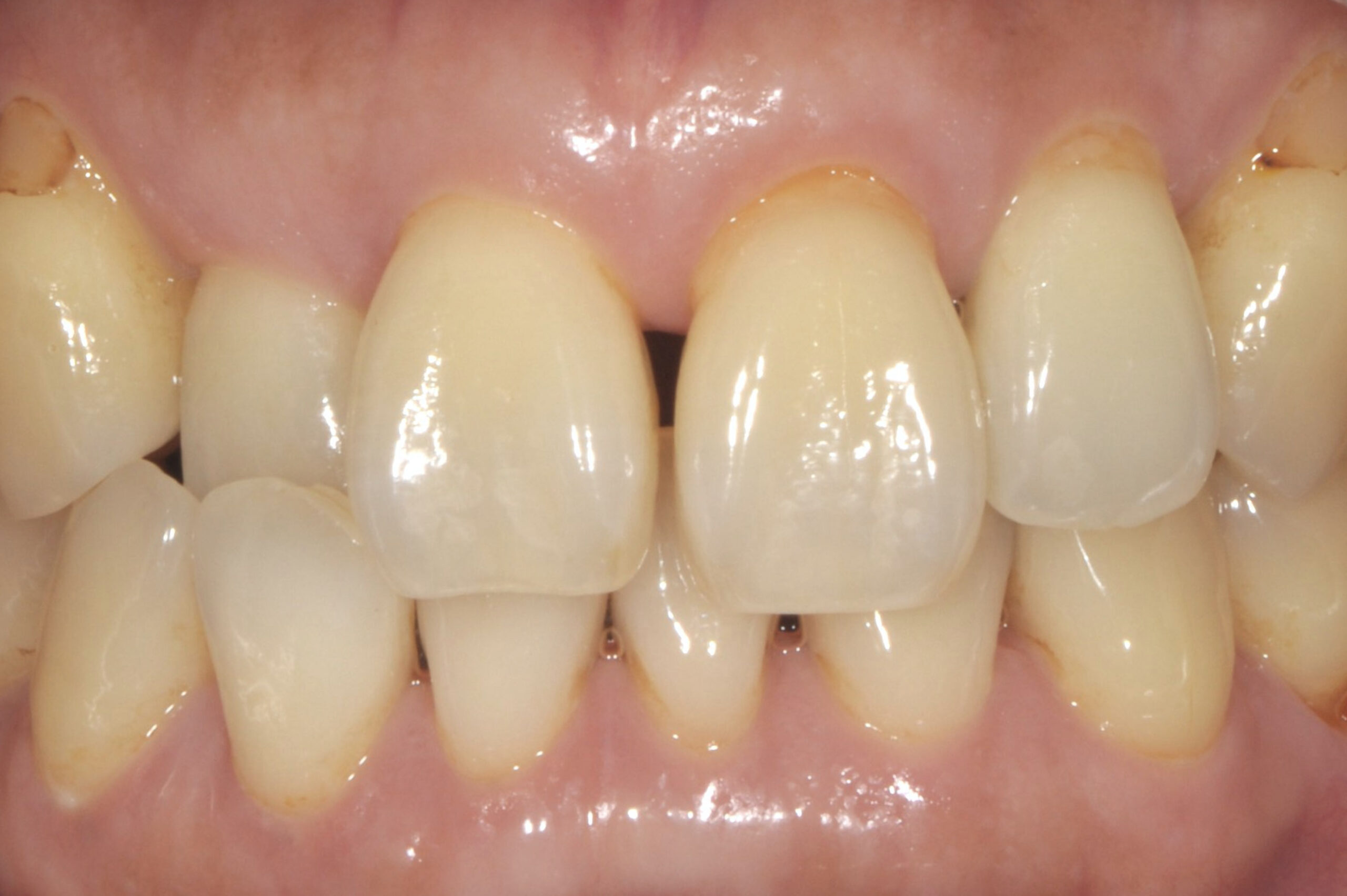 30代女性 前歯の隙間（すきっ歯）を即日で歯を削らずにダイレクトボンディングにて埋めて、綺麗に白く治した審美症例 東鎌ヶ谷歯科